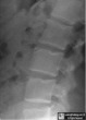 Limbus Vertebra